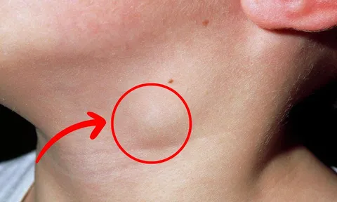 3 dấu hiệu bất thường ở vùng cổ cảnh báo K: Nhiều người chủ quan đã quá muộn