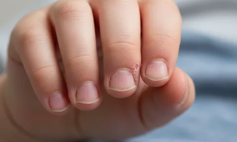 Trẻ hay cắn móng tay tưởng vô hại, bé 5 tuổi phải phẫu thuật vì nhiễm trùng nặng: Bố mẹ đừng chủ quan