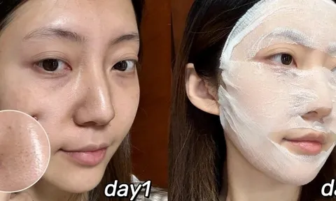 Blogger 28 tuổi dưỡng trắng da, mờ thâm nám nhờ routine khoa học tại nhà