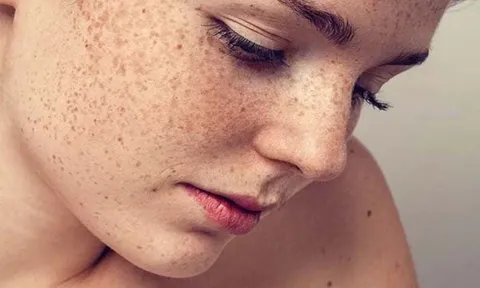 Đốm đồi mồi trên da: nguyên nhân, dấu hiệu và cách cải thiện hiệu quả