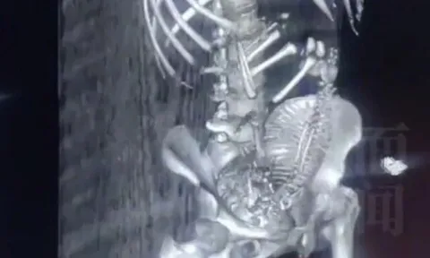 Con gái đi học về xuất hiện bất thường ở vùng kín, mẹ vội đưa vào viện khám, kết quả chụp CT khiến bác sĩ tái mặt