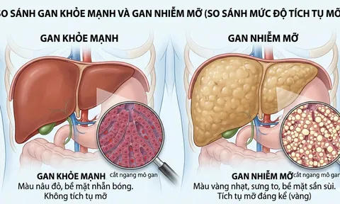 Gan nhiễm mỡ tăng nhanh ở người Việt: Bác sĩ chỉ ra 3 thói quen quen thuộc nhiều người mắc phải