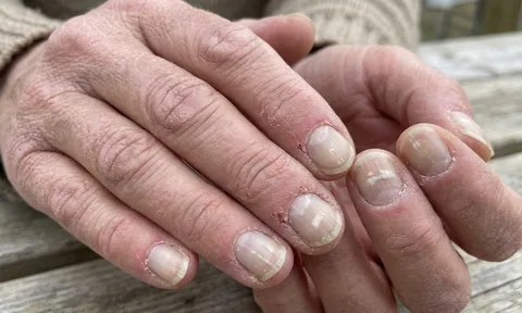 Tay và chân xuất hiện 7 dấu hiệu này, có thể là tín hiệu thận đang gặp vấn đề