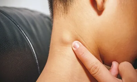 5 dấu hiệu dễ nhận biết nhất của ung thư tuyến giáp