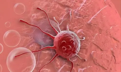 3 căn bệnh ung thư này tiến triển với tốc độ đáng báo động, cách phát hiện sớm