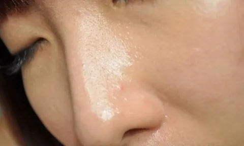 4 nguyên nhân khiến lỗ chân lông to và cách chăm sóc phù hợp cho từng tình trạng da