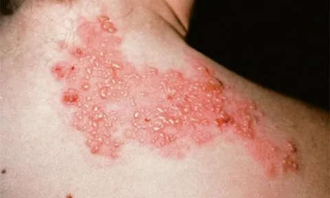 Đây là 3 căn bệnh được y học đánh giá là gây đau đớn nhất