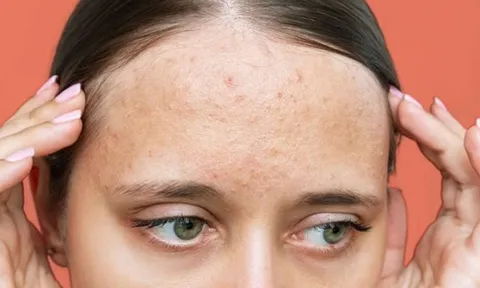 Nhận diện sẹo rỗ và 5 phương pháp cải thiện giúp làn da dần mịn màng hơn