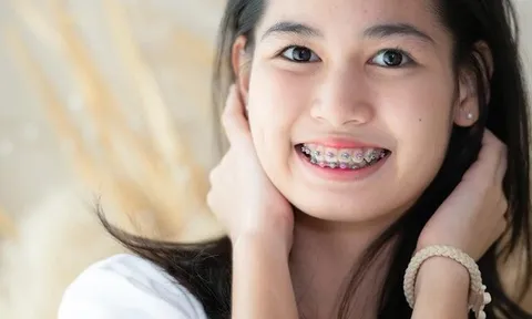 Niềng răng có hết cằm lẹm không? Các phương pháp niềng răng hiệu quả