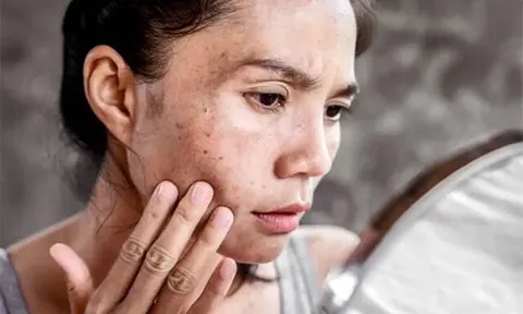 Tia UV - “kẻ phá hủy thầm lặng” khiến da già đi chóng mặt nếu không được bảo vệ đúng cách