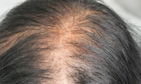 Loại lá chống rụng tóc, kích thích mọc tóc con hiệu quả nhưng đang bị bỏ ph
