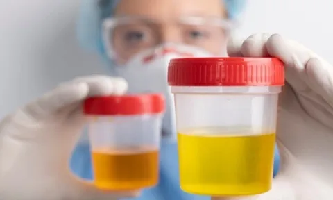 Ngoài bệnh phụ khoa, màu nước tiểu còn cảnh báo nguy cơ mắc căn bệnh nguy hiểm nào ở chị em phụ nữ?