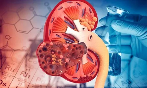 4 dấu hiệu người bị suy thận, buổi tối gặp 1/5 cũng dè chừng