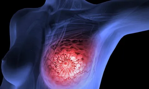 5 dấu hiệu rõ ràng cảnh báo ung thư vú: Đặc biệt dấu hiệu thứ 2 thường xem nhẹ