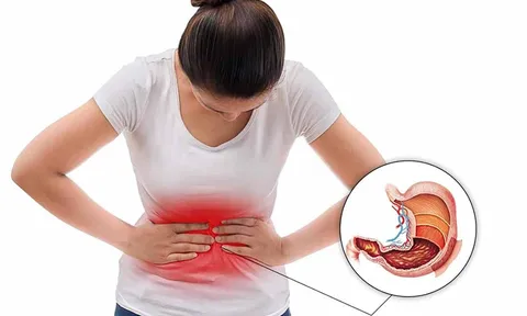 5 biểu hiện của bệnh dạ dày: Có 1 cũng nên đi khám sớm