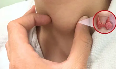 5 nhóm người có nguy cơ cao bị ung thư tuyến giáp