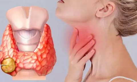 5 dấu hiệu ung thư tuyến giáp giai đoạn 1: Biết sớm sẽ kéo dài sự sống