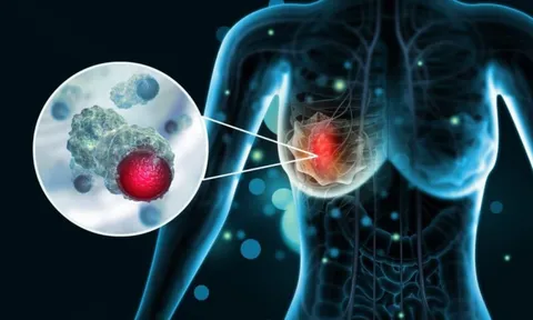 5 dấu hiệu ung thư vú giai đoạn 1: Phát hiện sớm có thể kéo dài sự sống