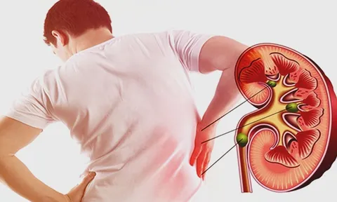 5 dấu hiệu suy thận giai đoạn đầu ở nam giới: Biết sớm tránh chạy thận suốt đời