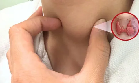 5 nhóm người có nguy cơ cao bị ung thư tuyến giáp