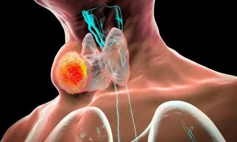 5 dấu hiệu ung thư tuyến giáp giai đoạn cuối: Đặc biệt dấu hiệu đầu tiên