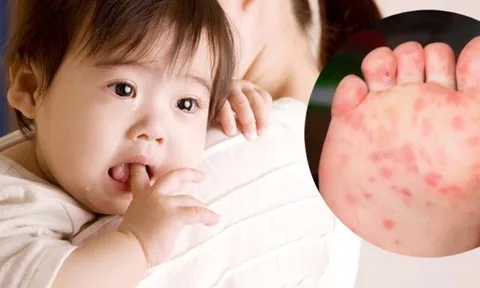 Bệnh tay chân miệng diễn biến phức tạp, chuyên gia chỉ 2 nguyên nhân và đưa giải pháp phòng bệnh kết hợp
