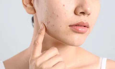 Giảm mụn ẩn hiệu quả: xây dựng quy trình chăm sóc da đúng cách từ những bước cơ bản