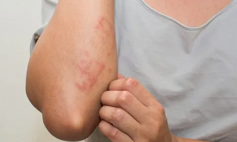 Thiếu nữ tổn thương nhiều vùng cơ thể vì loại vật nuôi quen thuộc, bác sĩ cảnh báo nguy cơ khi thời tiết nắng nóng