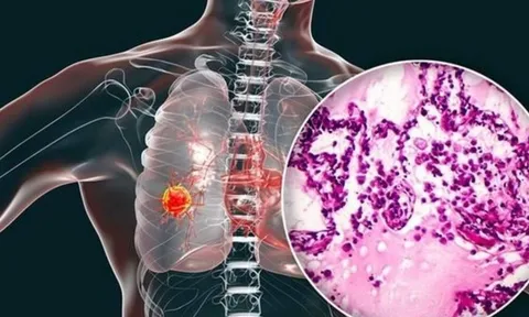 Cảnh báo ung thư phổi gia tăng: Bác sĩ khuyên tránh 4 loại thực phẩm để lâu trong tủ lạnh