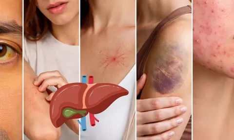 Da xuất hiện 5 dấu hiệu này, đừng chủ quan: Gan có thể đang “kêu cứu”