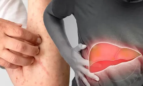 5 biểu hiện sớm của bệnh gan có 1 dấu hiệu cũng nên đi khám sớm