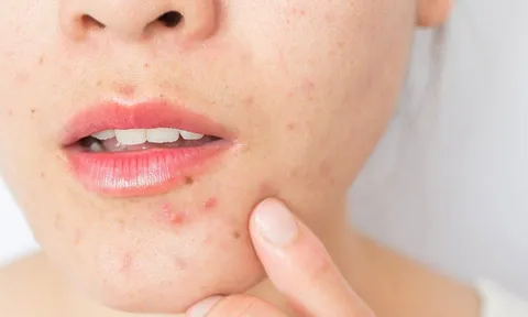 6 sai lầm khiến mụn kéo dài dai dẳng và cách xử lý đúng để da phục hồi hiệu quả