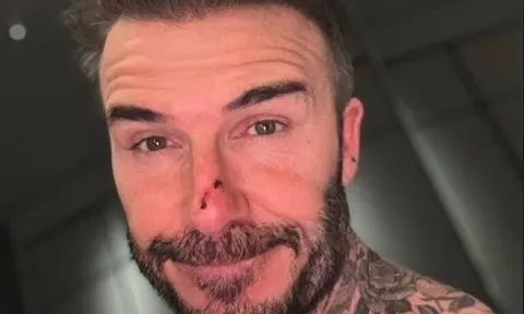 David Beckham bị con gái cắn xước mũi
