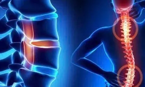 Sáng cứng cổ, chiều mỏi lưng: Khi đau cột sống trở thành vấn đề cần chăm sóc lâu dài