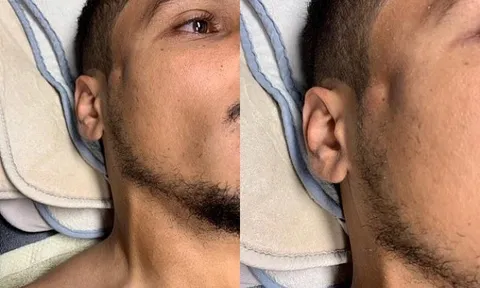 Kinh dị! Ibrahimovic thúc cùi chỏ... gây lõm mặt, vỡ xương đối thủ