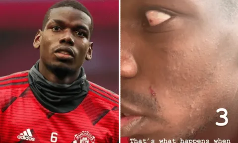 Va chạm trên sân tập, Pogba "trầy da tróc vẩy" trước Lindelof