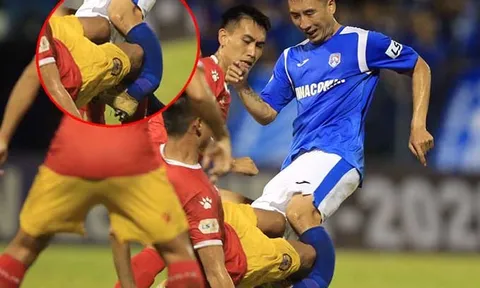 SỐC: "Iniesta xứ Mỏ" gãy gập xương ống đồng, vụt mất cơ hội lên tuyển