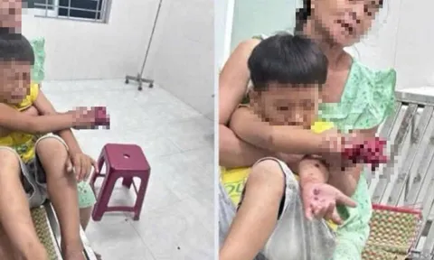 Cháu bé bị dập bàn tay nghi do điện thoại nổ khi đang sạc pin