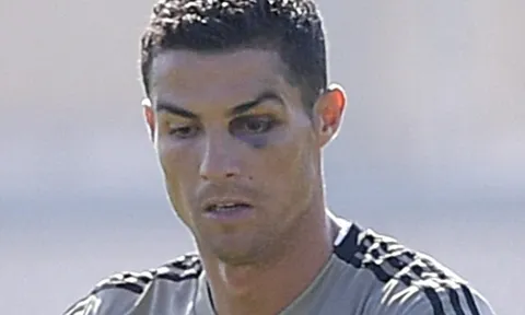 Ronaldo bất ngờ xuất hiện với quầng mắt thâm tím