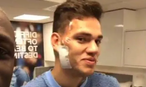 Ederson tự tin khoe thẹo sau cú vào bóng của Mane