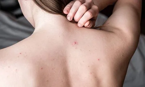 Cải thiện mụn lưng và da sần sùi tại nhà: Routine đơn giản giúp da body mịn màng rõ rệt
