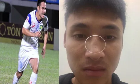 Cầu thủ SLNA đấm gãy mũi đối phương là Phạm Thế Nhật