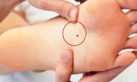 4 nốt ruồi vùng kín mang lại may mắn: Đừng dại xóa đi