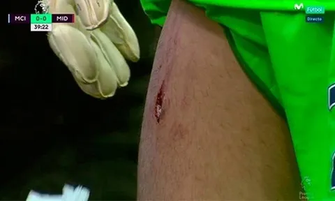 Chấn thương sau cú bị đạp gầm giày của Victor Valdes