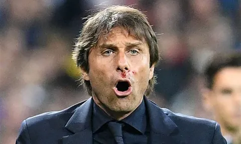 Ăn mừng quá đà, Conte bị vỡ cả mũi