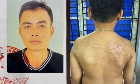 Khởi tố người cha bạo hành con ruột gây thương tích 36% gây phẫn nộ