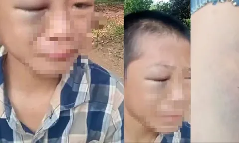 Đang xác minh vụ bé trai 12 tuổi, nghi bị bố và mẹ kế bạo hành