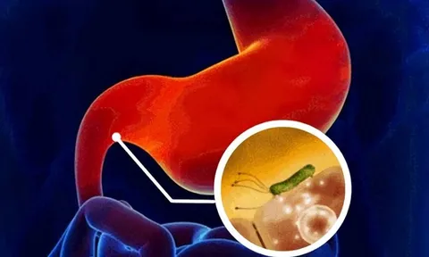 5 dấu hiệu cảnh báo sớm về K dạ dày, biết sớm tăng tỷ lệ sống lên hơn 90%