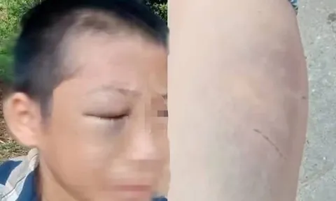 Bé trai nghi bị mẹ kế bạo hành nhiều lần: Người bố lên tiếng xin lỗi gia đình vợ cũ