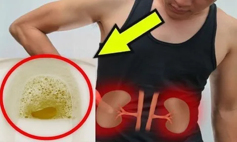 Đi tiểu thấy nhiều bọt có phải bị suy thận?